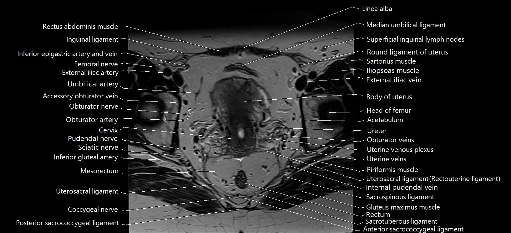 Axial cross sectional anatomy of female pelvis (MRI 3T) image 22.webp